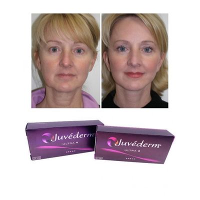 6~9ヶ月 Juvederm Dermal Filler Gel オンラインおよび店舗で購入可能