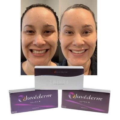 Juvederm 皮膚唇のフィルラー ヒアルロン酸 交差リンクインジェクション
