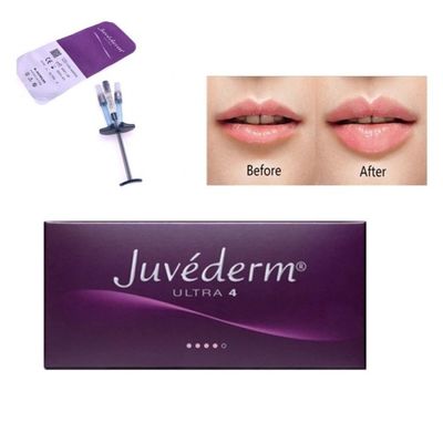 Allergan Juvederm 皮膚充填剤 インジェクション Ultra4 With Lido