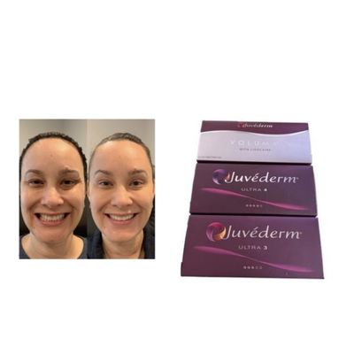 Juvederm インジェクタブル皮膚フィルラー Juvederm Ultra3 Ultra4 Voluma