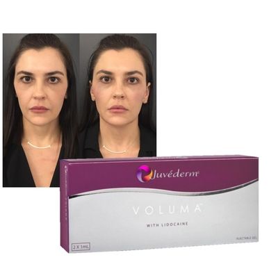 2ml ヒアルロン酸皮膚充填剤 JUVEDERM 注射用ゲル くるみ充填剤